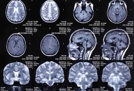cerveau