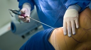 Liposuccion mortelle d'une Française à Tunis : Les médecins tunisiens blanchis