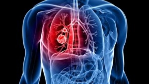 2500 cas de cancer de poumons enregistr&eacute;s chaque ann&eacute;e en Tunisie