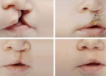 "Bec de li&egrave;vre" : Des op&eacute;rations gratuites au profit des enfants &agrave; l'h&ocirc;pital Sahloul