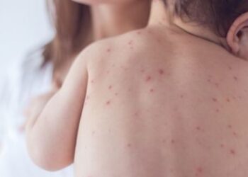 580 cas de rougeole recens&eacute;s &agrave; Kasserine