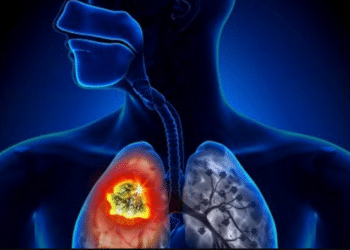 Tunisie : 22 cas de tuberculose sur 100 mille habitants