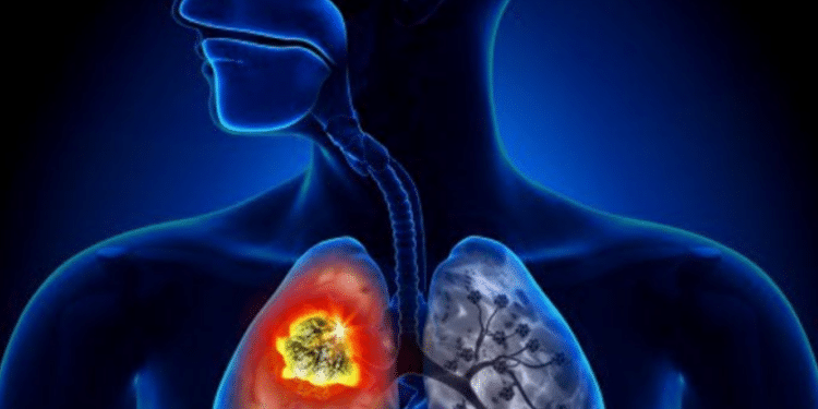 Tunisie : 22 cas de tuberculose sur 100 mille habitants