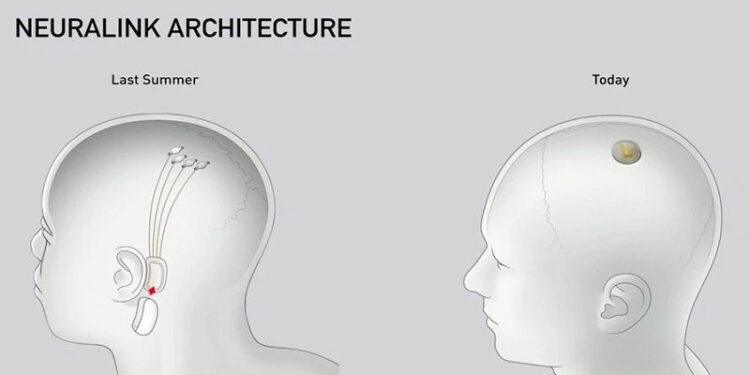 Neuralink implant cérébral