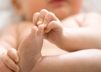 Premier cas d'ischiopagus en Tunisie