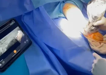 Tunisie : Avancée chirurgicale avec l’opération par ultrasons pour soulager la compression nerveuse