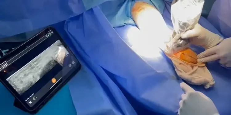 Tunisie : Avancée chirurgicale avec l’opération par ultrasons pour soulager la compression nerveuse