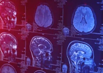 Tunisie : Plus de 100.000 cas d’Alzheimer recensés, alerte sur un enjeu de santé publique