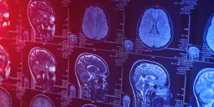 Tunisie : Plus de 100.000 cas d’Alzheimer recensés, alerte sur un enjeu de santé publique