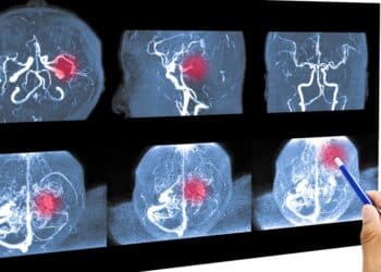 Santé publique : En Tunisie, un AVC toutes les trente minutes, un décès toutes les deux heures