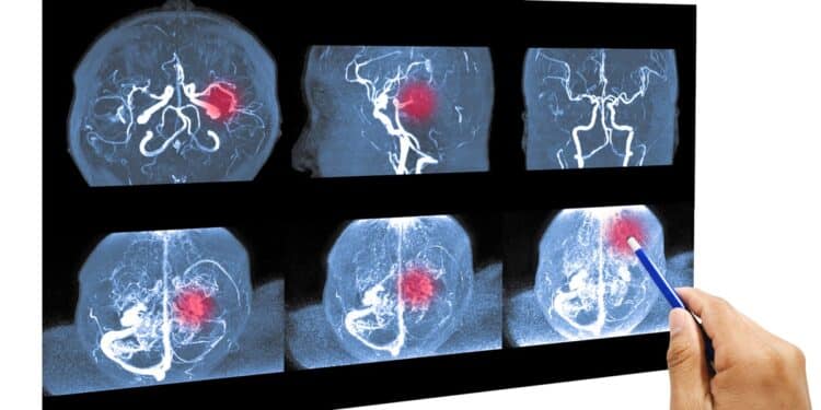 Santé publique : En Tunisie, un AVC toutes les trente minutes, un décès toutes les deux heures